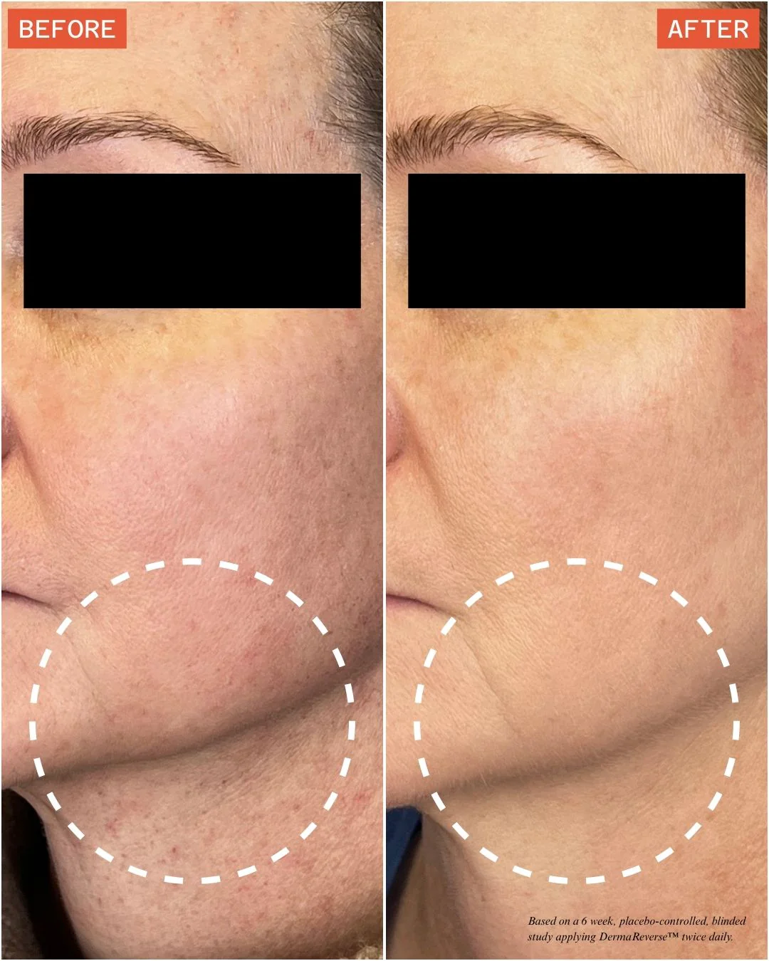 Split-face clinical study photo: one side treated with DermaReverse, one side placebo, after six weeks.